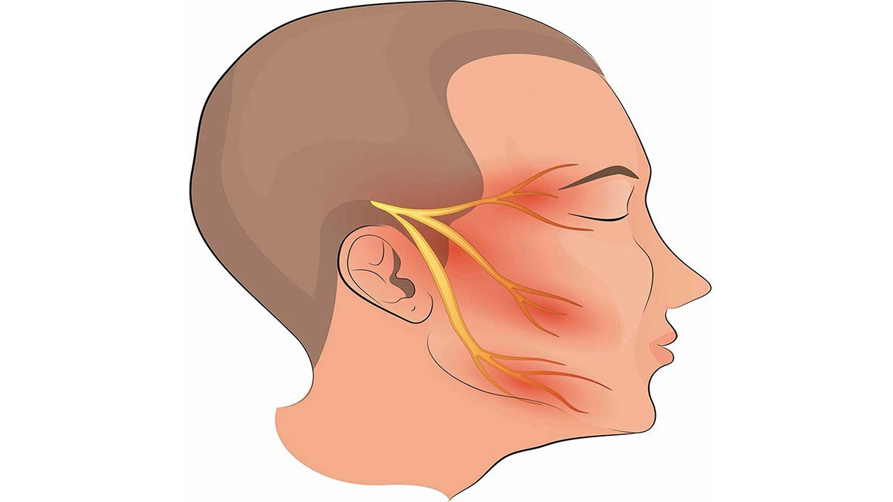 নিউরালজিয়া বা মুখের স্নায়ুতে তীব্র ব্যাথা হলে যা জানা দরকার