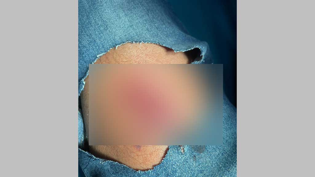 পল্লবীতে দুর্বৃত্তদের ছোঁড়া ককটেলে পুলিশের এএসআই আহত