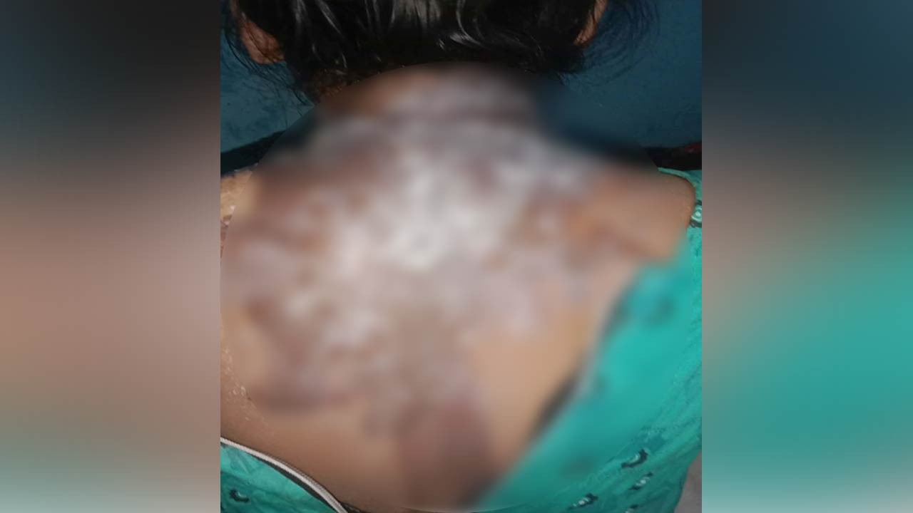 বগুড়ার শেরপুরে শাশুড়ির বিরুদ্ধে গৃহবধূর পিঠে গরম তেল ঢেলে দেওয়ার অভিযোগ