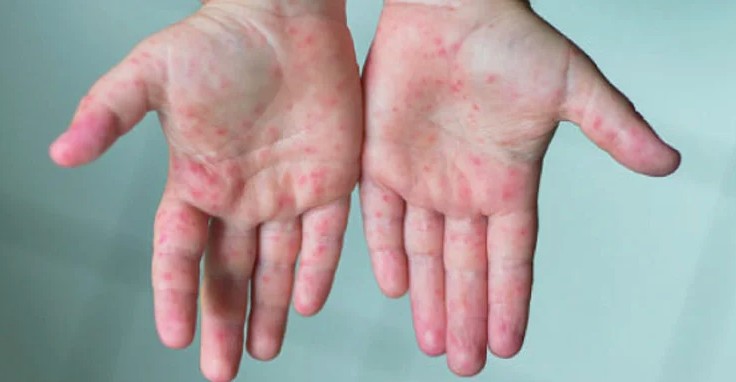  হাম : ২৪ ঘণ্টায় ৫ জনের মৃত্যু  