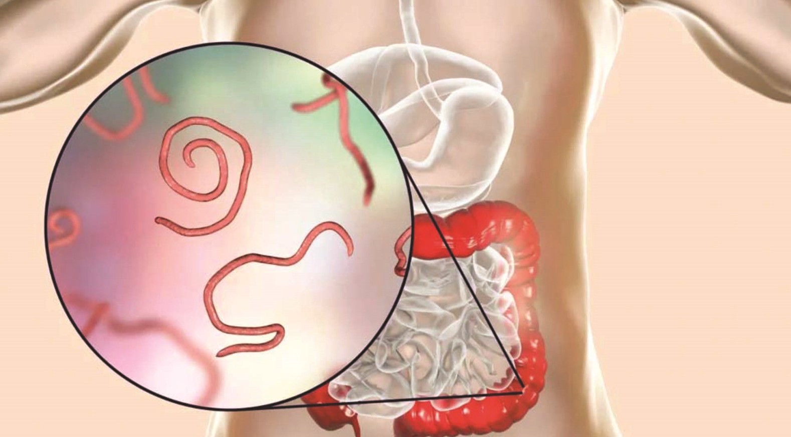 পেটের অসুখ পরজীবী: কারণ ও প্রতিকার