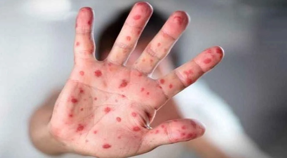 হামে ২২ দিনে ২০ জনের মৃত্যু