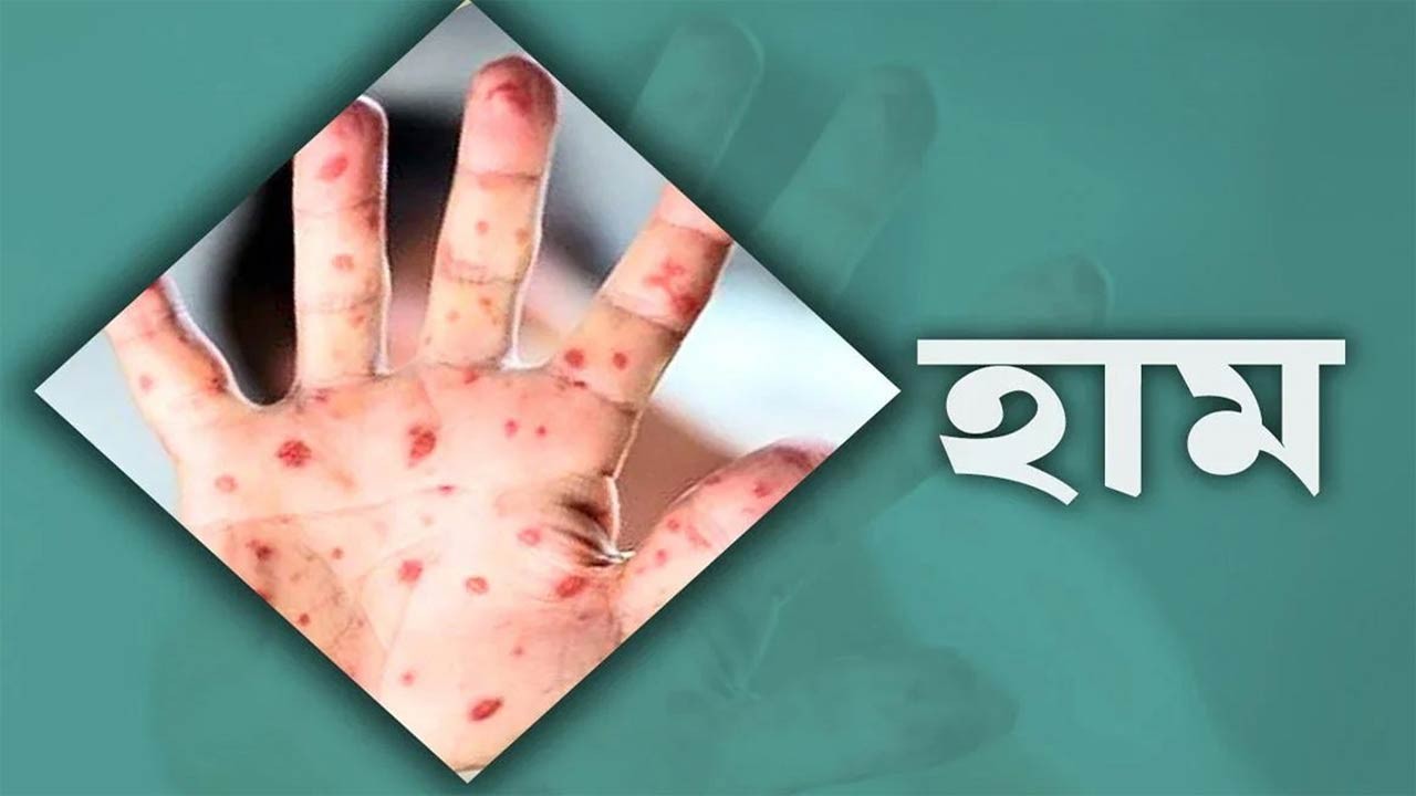 ঠাকুরগাঁওয়ে ১২৮ জনের শরীরে হামের উপসর্গ শনাক্ত