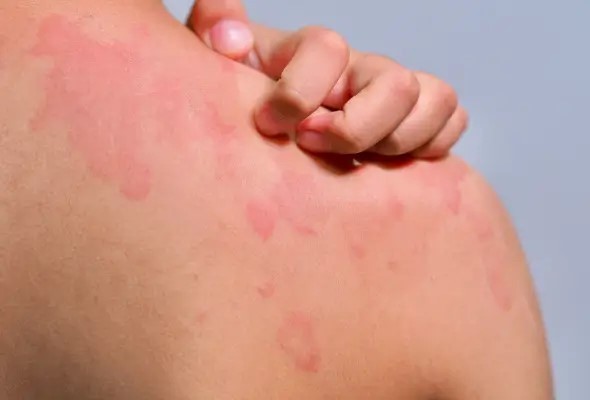 গর্ভাবস্থায় চামড়ার ফুসকুড়ির কারণ ও প্রতিকার